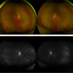 cmv retinitis in immunocompromised patient