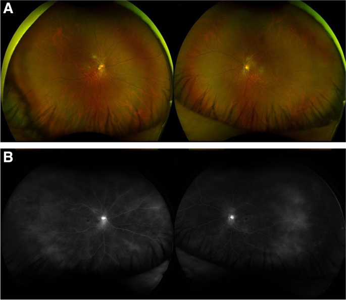 cmv retinitis in immunocompromised patient