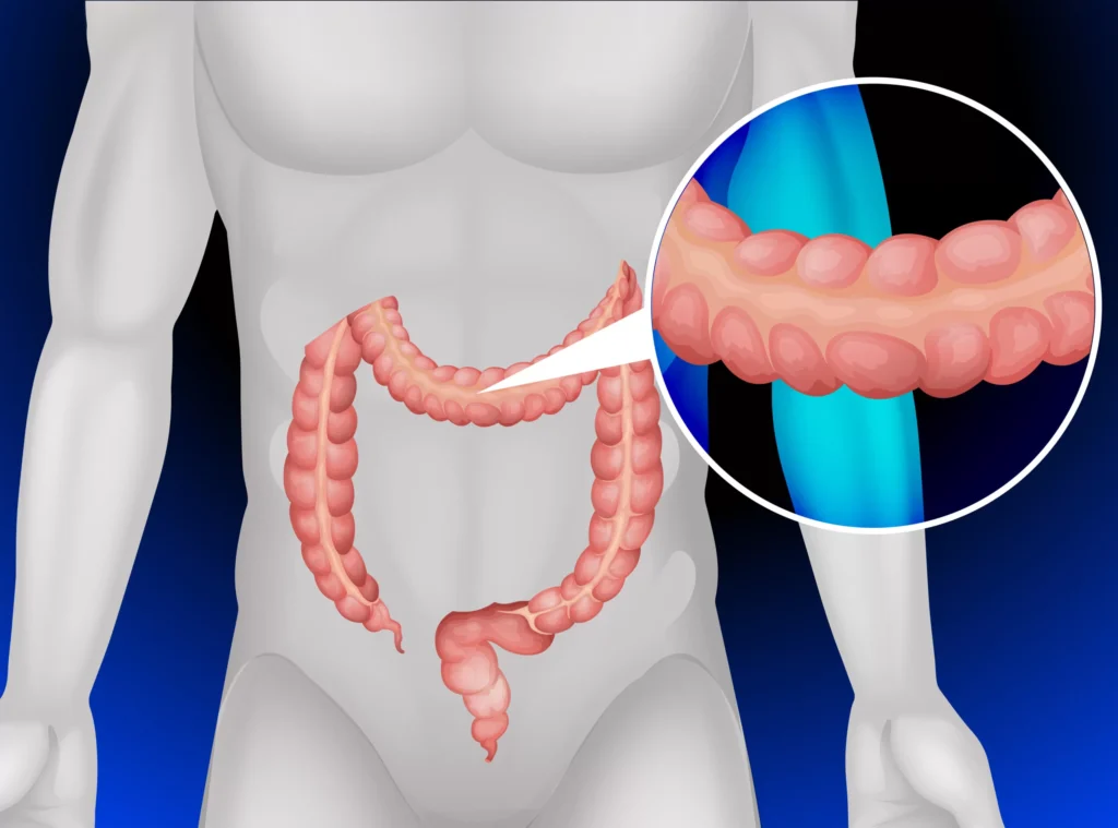 collagenous colitis