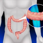 collagenous colitis