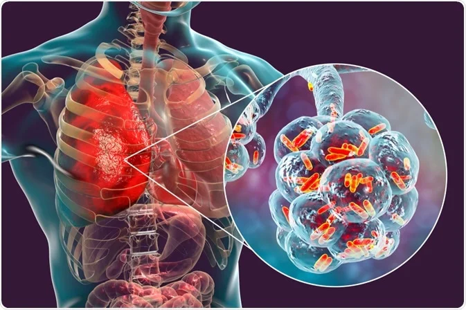 community acquired bacterial pneumonia