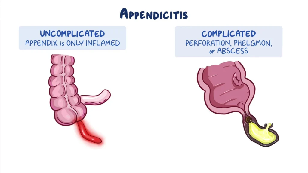 complicated appendicitis