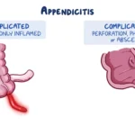 complicated appendicitis