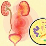 complicated bacterial infection of urinary tract