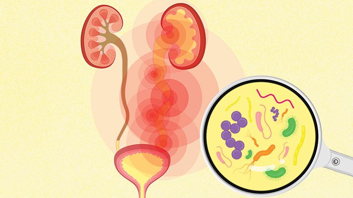 complicated bacterial infection of urinary tract