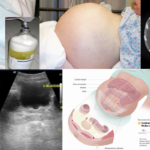 complicated bacterial peritonitis