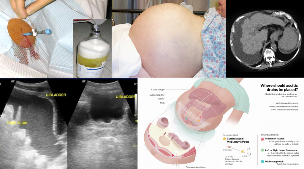 complicated bacterial peritonitis