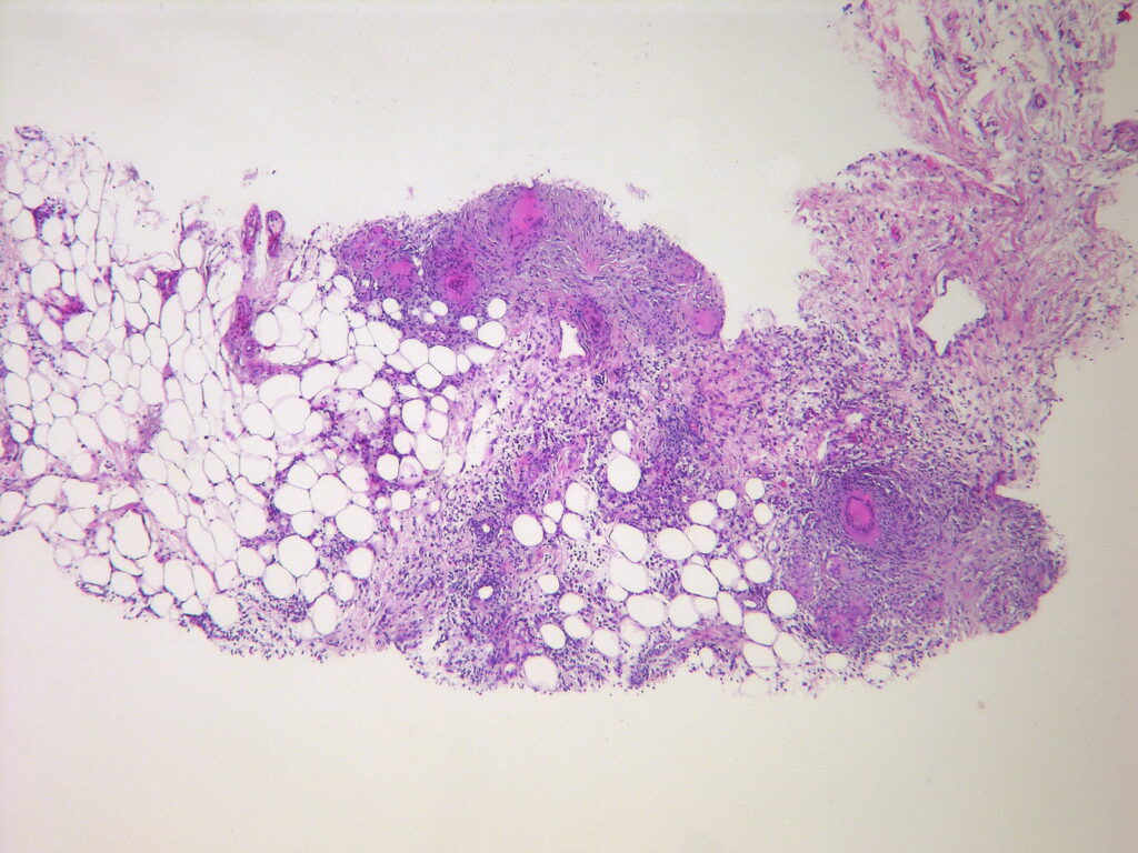 complicated bacteroides peritonitis