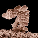 complicated e. coli peritonitis