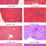 complicated klebsiella peritonitis