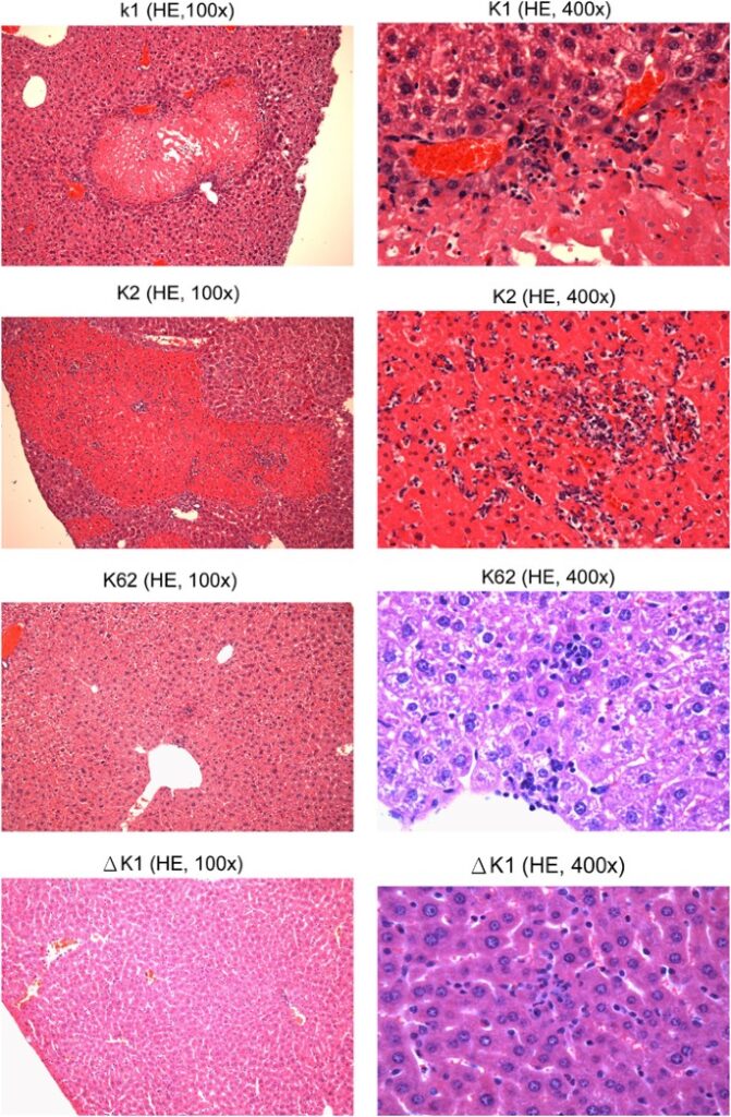 complicated klebsiella peritonitis