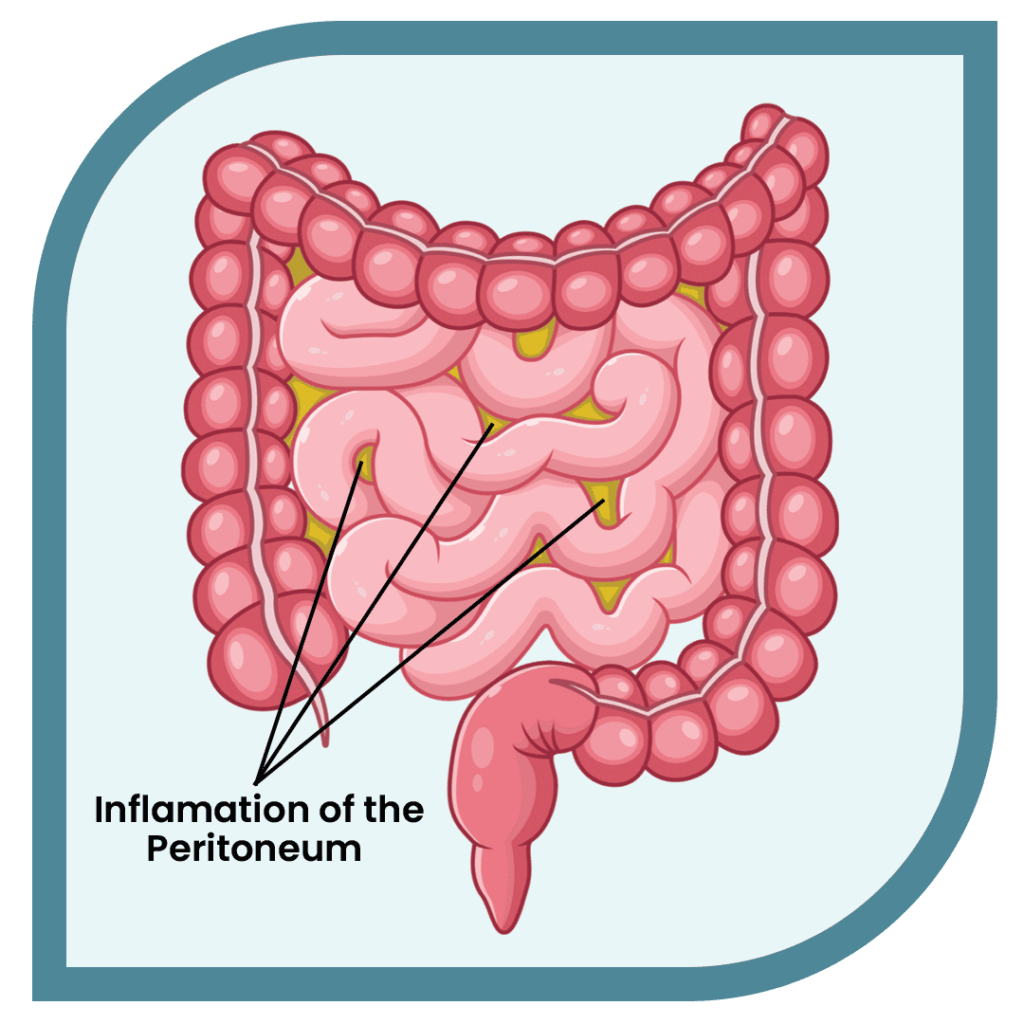 complicated peptostreptococcus peritonitis