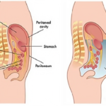 complicated peritonitis due to clostridium