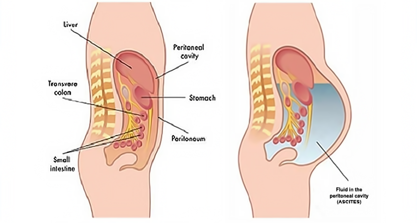 complicated peritonitis due to clostridium