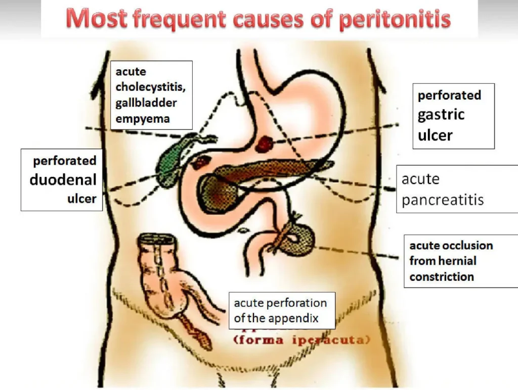 complicated peritonitis due to eubacterium