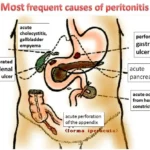 complicated peritonitis due to eubacterium