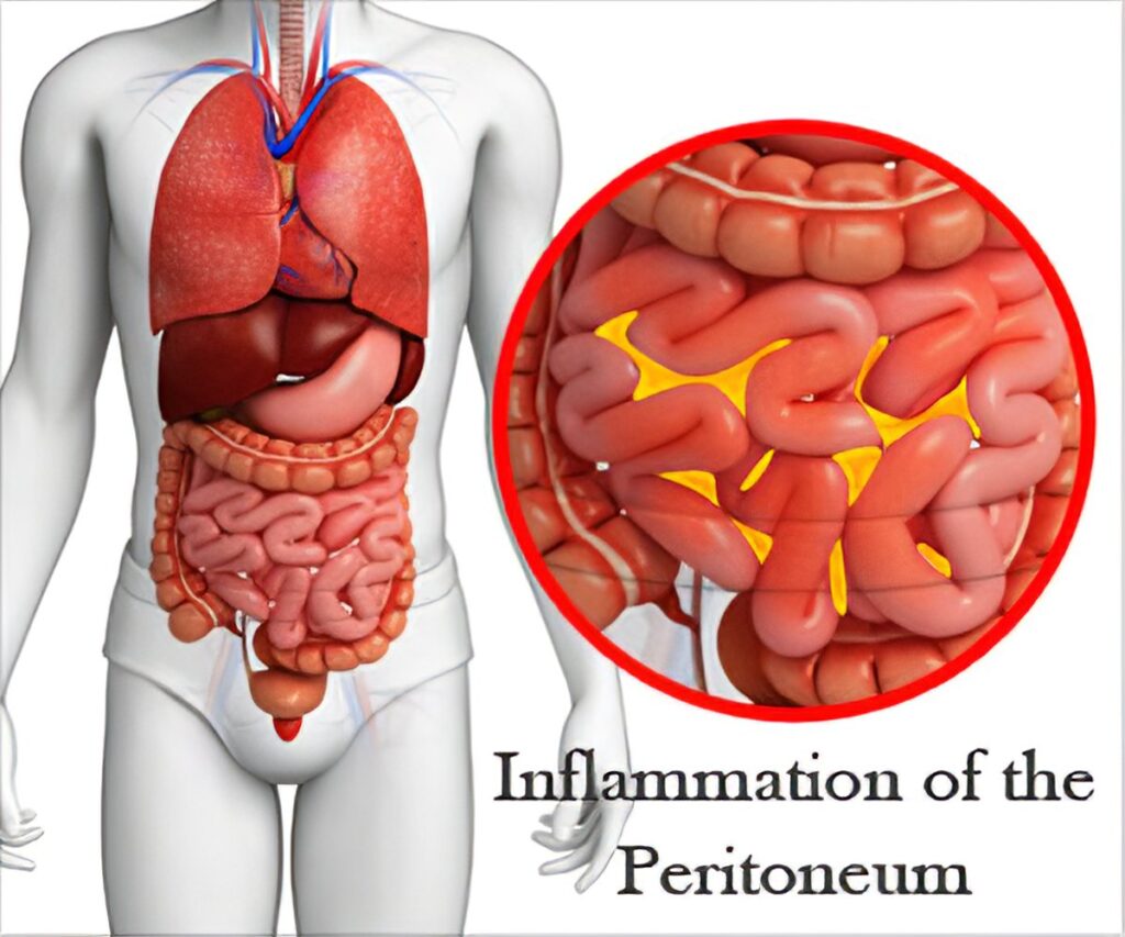 complicated pseudomonas aeruginosa peritonitis