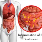 complicated pseudomonas aeruginosa peritonitis