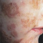 complicated skin and skin structure enterococcus faecalis infection