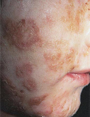 complicated skin and skin structure enterococcus faecalis infection