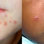 complicated skin and skin structure infection