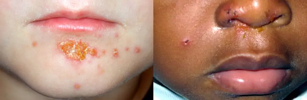 complicated skin and skin structure infection