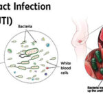 complicated urinary tract infection due to acinetobacter