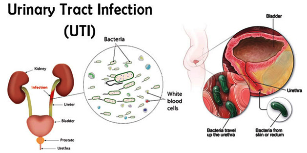 complicated urinary tract infection due to acinetobacter