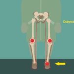 concomitant hypertension and osteoarthritis