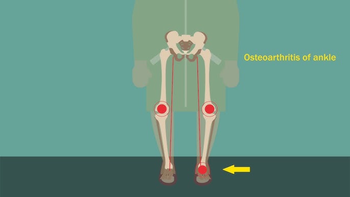 concomitant hypertension and osteoarthritis