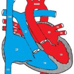 congenital heart defect requiring patency of ductus arteriosus