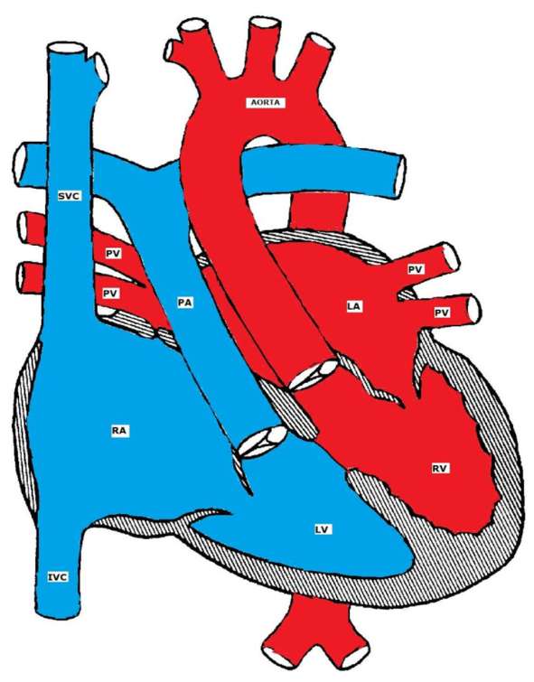 congenital heart defect requiring patency of ductus arteriosus