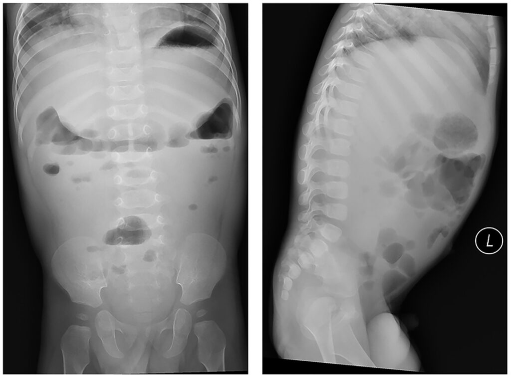 congenital sucrase-isomaltase deficiency