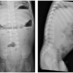 congenital sucrase-isomaltase deficiency