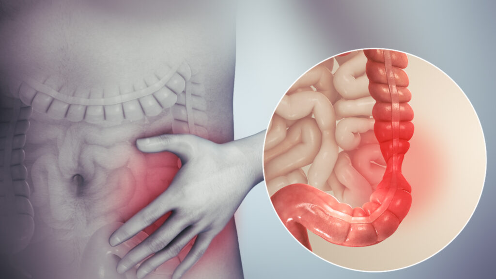 constipation predominant irritable bowel