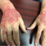 contact dermatitis