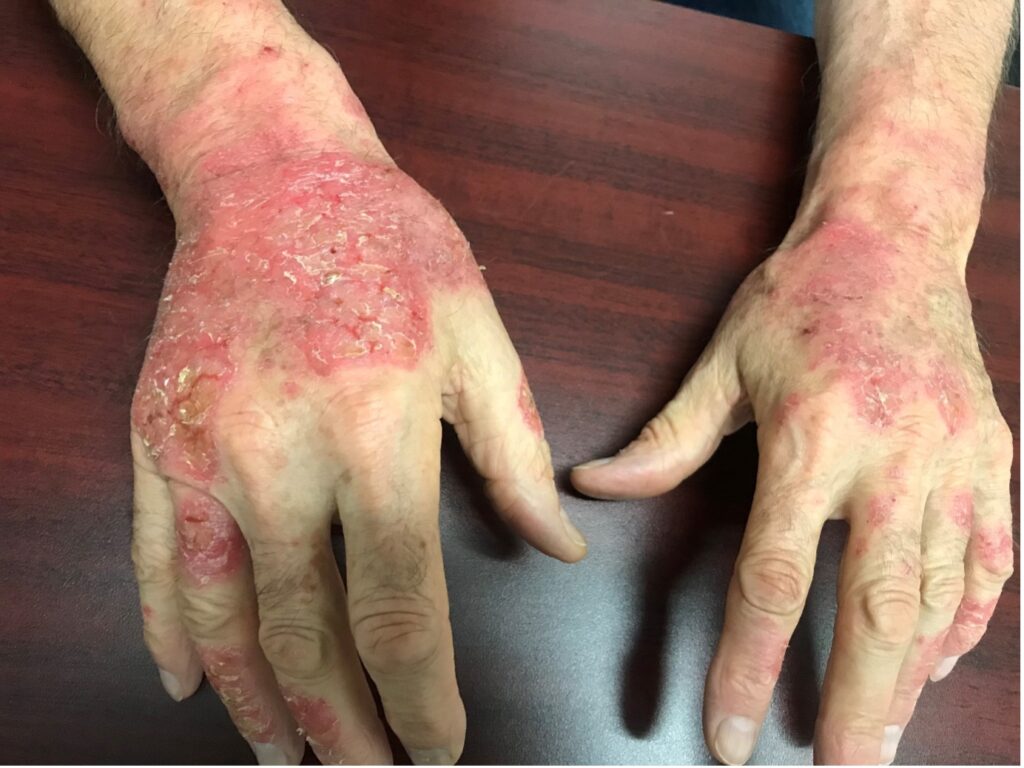 contact dermatitis