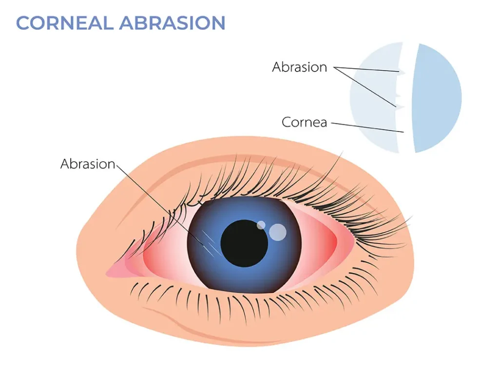 corneal abrasion