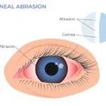 corneal abrasion