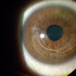 corneal ectasia following refractive surgery