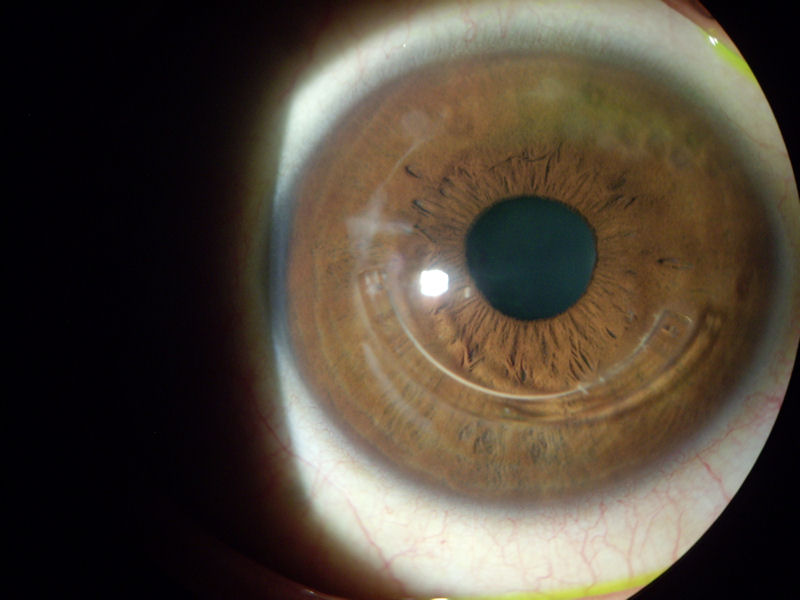 corneal ectasia following refractive surgery