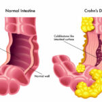 crohn's disease