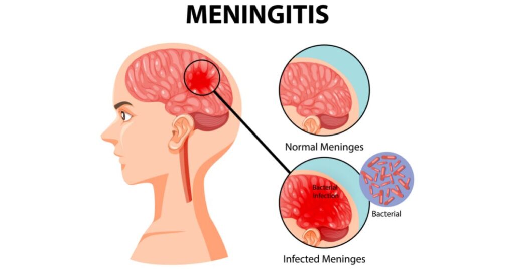 cryptococcal meningitis