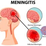 cryptococcal meningitis