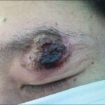 cryptococcosis