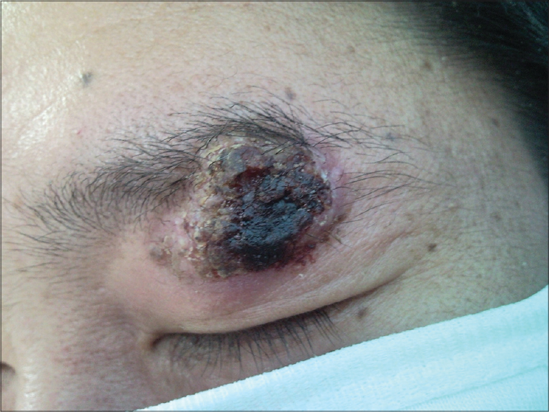 cryptococcosis