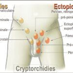 cryptorchidism