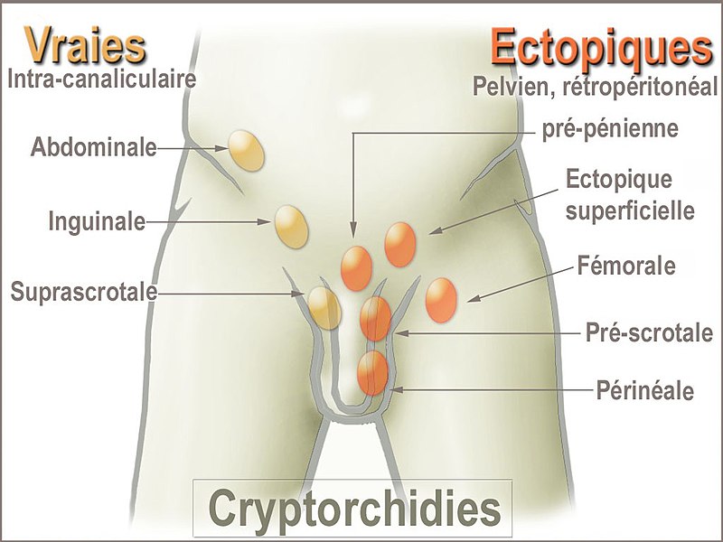 cryptorchidism