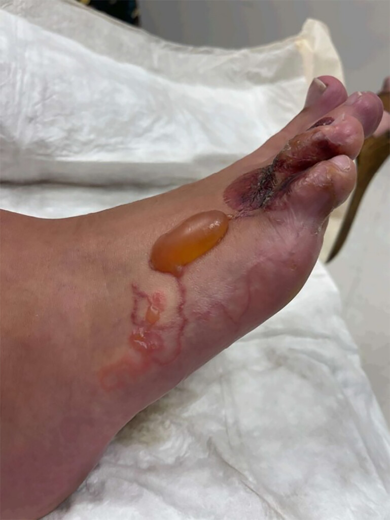 cutaneous larva migrans