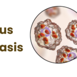 cutaneous leishmaniasis